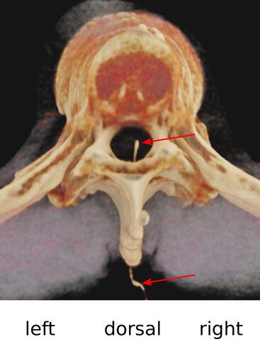 Figure 3 Shaded surface display volume rendering (SS-VRT) of the thoracic vertebral column in head-feet-orientation: central, slightly right paramedian, position of the catheter inside the spinal canal. Red arrows indicate catheter.