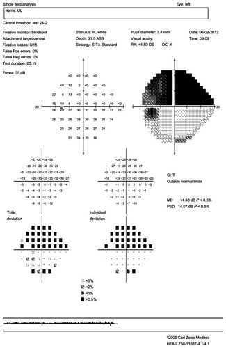 Figure 1 Standard automated perimetry.Abbrevations: PSD, pattern standard deviation; MD, mean deviation; HFA, Humphrey Field Analyzer; DOB, date of birth; GHT, glaucoma hemifield test; RX, refraction; DC, power of the cylinder; Pos, positive; Neg, negative.