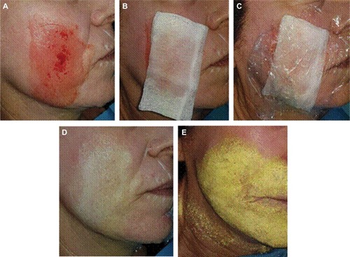 Figure 3 Treatment of acne scars with single abrasion technique.