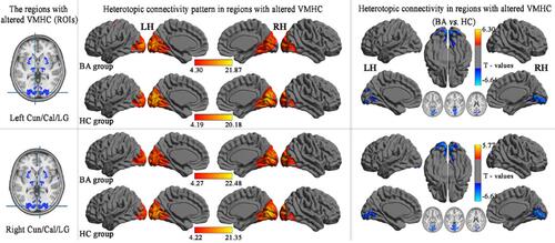 Figure 4 Group comparisons seed-based FC of the altered VMHC between the BA and HC seed regions in bilateral Cun/Cal/LG. (P < 0.01, GRF-corrected at a cluster level of P < 0.05).