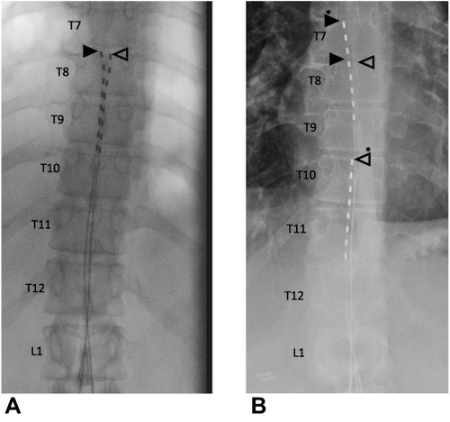 Figure 1 Example of a final AP fluoroscopic image obtained at the time of a trial lead placement (A) depicts the positions of the anatomically left and right lead tips at the level of the T8 vertebral body (open arrowhead and closed arrowhead, respectively). Example of an AP radiograph of the thoracic spine acquired seven days after a trial lead placement (B) demonstrates interval migration of the leads. From its original position (open arrowhead), the left lead tip has migrated caudally by 2.0 vertebral body heights to a new position at the level of the T10 vertebral body (open arrowhead and asterisk). The right lead tip has migrated from its original position (closed arrowhead) 0.8 vertebral body heights cranial to a new position at the level of the T7 vertebral body (closed arrowhead and asterisk).