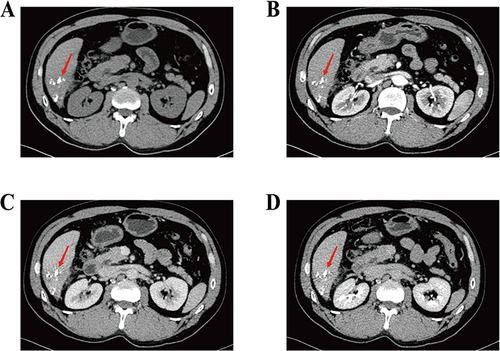 Figure 6 Computed tomography (CT) scans before the second operation. Necrotic focus fused into a mass (red arrow), with a maximum area of about 7.0cm×2.9cm (A) plain scan; (B) arterial phase; (C) portal venous phase; (D) venous phase.
