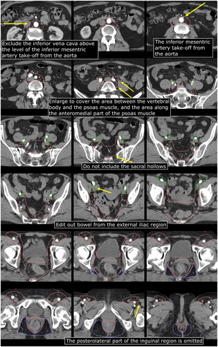 Figure 2. Contouring of the CTVe in anal cancer. Orange, CTVe including para-aortic and common iliac; green, external iliac; purple, ischiorectal fossa.