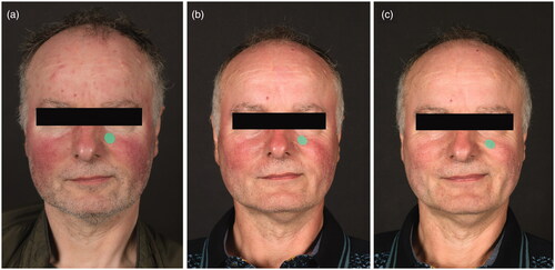 Figure 2. Rosacea in a 56-year old man, (a) at baseline, (b) at week 16 of treatment with topical ivermectin 1% once daily, and (c) 12 weeks post-treatment. Notice the disappearance of papules and pustules at the forehead and prominent erythema at the cheeks, while telangiectasias and residual erythema at both cheeks are persisting. The green dots serve as a tool to assess clinical erythema.