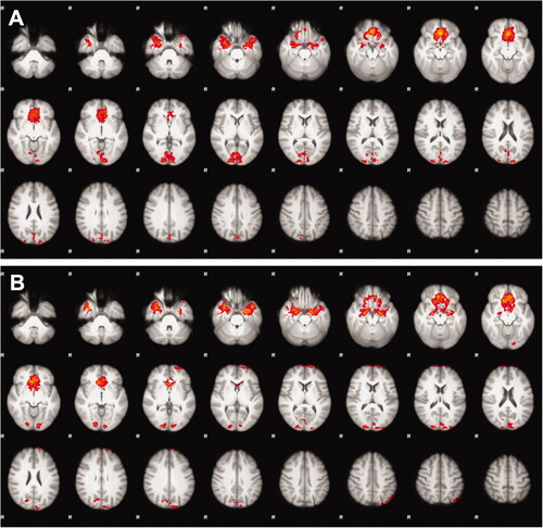 Figure 2. Mean differences in whole-brain functional magnetic resonance imaging activity between the interference and control tasks in the multisource interference task, i.e., the difference in neuronal activity required to perform the additionally more cognitively demanding interference tasks compared with the control tasks, revealed fMRI activity pattern in the cingulo-fronto-parietal attention network as excepted, but showed no significant differences between the adult survivors of (A) childhood acute lymphoblastic leukemia and (B) controls.