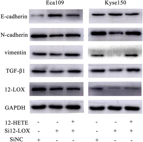 Figure 4 Regulation of si12-LOX and 12(S)-HETE in EMT-related proteins in ESCC cells. The left panel showed that the expression of 12-LOX, TGF-β1, vimentin and N-cadherin in Eca109 cells were reduced after treated by si12-LOX and that of E-cadherin was increased, and the changes were partly relieved after addition of 12(S)-HETE; right panel shows the similar results in Kyse150 cells.Abbreviations: ESCC, esophageal squamous cell carcinoma; EMT, epithelial-mesenchymal transition.