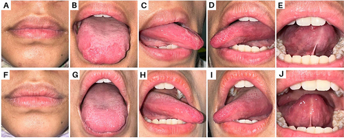 Figure 1 (A) shows dry lips; (B–E) intra-oral examination of the dorsal tongue, right lateral tongue, left lateral tongue, and ventral tongue at the first visit; (F–J) shows that the lesion improved clinically at the follow-up visit.