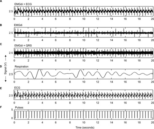 Figure 5 Signals obtained from a neonate patient in the neonatal intensive care unit of the Hospital General de Medellín Luz Castro de Gutiérrez (Medellín, Antioquia, Colombia) during a period of 20 seconds.