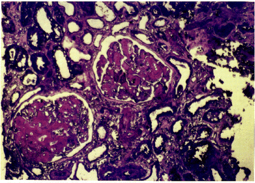 Figure 1. Positive results for amyloid deposits in the glomeruli and the wall of a blood vessel (×150).