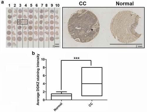 Figure 1. Expression levels of DGKZ in cervical cancer tissues and paired adjacent normal cervical tissues. (a) Immunohistochemical staining and Tissue Microarray Assay (TMA) of DGKZ protein in 31 tumor tissues and 31 adjacent non-tumor tissues from CC patients. (b) Relative expression of DGKZ in CC and normal group quantified by box-and-whisker plot. (***p < 0.001)