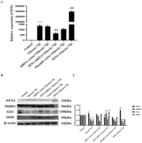 Figure 4 PFN1 was related to the inactivation of the Hedgehog signaling pathway in HK-2 cells induced with high levels of glucose for 72 h. (A) The shRNA and expression plasmid were successfully transfected in HK-2 cells. Q-PCR analysis indicating that the expression of PFN1 was significantly increased in the PFN1 overexpression group, while it was decreased in the PFN1 shRNA knockdown group. (B) Over-expression of PFN1 decreased the expression of Gli1, SHH, and MDH1, whereas PFN1 knockdown up-regulate those genes. (C) Protein expression was quantified by densitometry. Mean ± SD; n = 3; **P < 0.01 vs the control group; ##P < 0.01 vs the group treated with high levels of glucose for 72 h. Western blot of PFN1 (15 kDa), MDH1 (36 kDa), Gli1 (150 kDa), SHH (50 kDa), and β-actin (42 kDa).