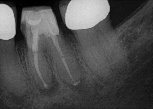 Figure 38. Post op 1 radiograph showing final outcome.