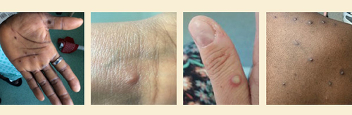 Figure 2 A visual example of Monkeypox rash. The rash is in form of lesions that are the commonest sign of Monkeypox disease. These evolve in four stages; Macular (a flat lesion), Papular (an elevated lesion), Vesicular (a fluid-filled lesion) and Pustular (an inflamed, pus-filled lesion) after that, they scab and flake. Photo Credit: NHS England High consequence Infectious Diseases Network. Adapted from Centers for Disease Control and Prevention. Monkeypox in the US [Internet]; 2022. Available from: https://www.cdc.gov/poxvirus/monkeypox/transmission.html.Citation12
