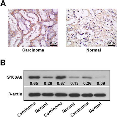 Figure 2. Protein expression of S100A8 in the renal tissues of RCC patients. Immunohistochemical (A) and western blotting (B) analysis of S100A8 expression in the renal tissues from patients with RCC.