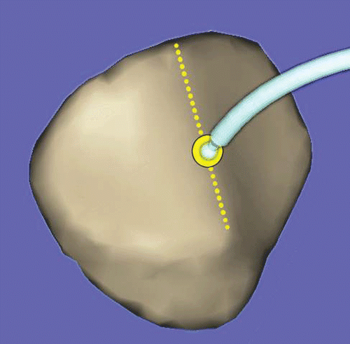 Figure 3. The trajectory point of the patella was defined by digitizing the centre of the median ridge on the posterior surface of the patella. This point also defined the origin of the patellar coordinate system. Although pre-arthroplasty kinematics were recorded before opening the joint capsule, the trajectory information was displayed only after opening the joint capsule and digitizing the posterior point. [Color version available online.]