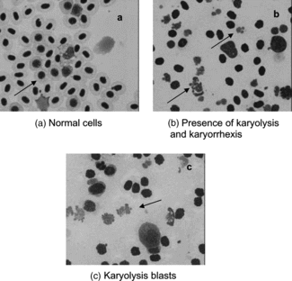 Figure 1 Normal and degenerative cells in tilapias (Oreochromis niloticus.) injected with (a) distilled water, and (b, c) Stichodactyla. toxin.