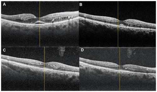 Figure 5 Radial OCT images of eye no.14 in group I ((A) At presentation, (B) 1 month after injection, (C) 3 months after injection, (D) 6 months after injection).