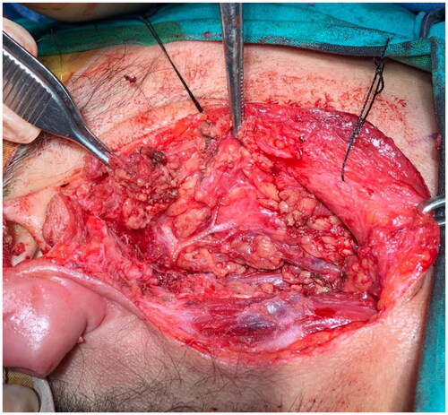 Figure 2. Image of the facial nerve preserved after the tumor is completely removed. The facial nerve is marked with white dots.
