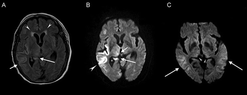 Figure 1. Brain magnetic resonance imaging (MRI) in patient 1 (A and B) and patient 2 (C). Axial view of FLAIR (A), and DWI (B) obtained during the first day of hospitalization. (A) T2-weighted images show multifocal high-intensity signals over right temporal lobe (short arrow), periventricle (arrowhead), and right thalamus (long arrow). (B) DWI shows high signals at right temporal lobe (arrowhead), right thalamus (short arrow), and right temporal horn (long arrow). (C) Axial view DWI obtained during the first day of hospitalization. DWI shows restrictive diffusion at the bilateral temporal lobes (arrows), and pulvinar regions of bilateral thalami (arrowheads). Note: FLAIR, fluid-attenuated inversion recovery; DWI, diffusion-weighted image.