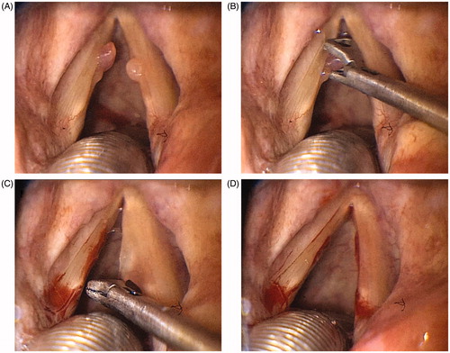 Figure 3. Laryngeal exposure with Airtraq® laryngoscope (Case No. 5 in Table 1). When applying the Airtraq® laryngoscope, the entire glottis was exposed including the anterior commissure, as grade 1 laryngeal exposure. The bilateral polys were also visualized clearly (A). The left vocal cord polyp was grasped with the special curved cutting forceps (B). The right vocal cord polyp was removed successfully by the same method (C). The vocal cord polyps were just removed completely (D).