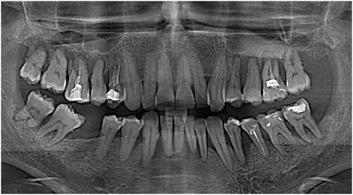 Figure 2 Panoramic radiograph at baseline.