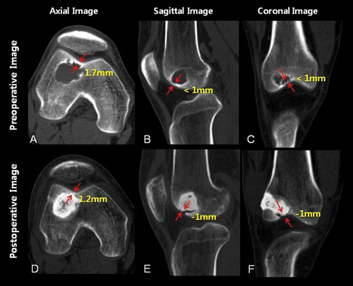 Figure 2. Articular involvement was evaluated by measuring subchondral bone thickness on the pre- and post-operative CT images. A representative case of punctured articular cartilage during burring is shown (case No. 4). The thickness of the subchondral bone between the tumor (or cement) and the outer cortex was measured via pre- and post-operative three-plane CT images. The distance between the two arrows indicates the subchondral bone thickness for each section of the matched CT images. On pre-operative sagittal and coronal images, the subchondral bone was extremely thin like paper (less than 1 mm) (B and C). This thin subchondral bone was punctured during surgery, and bone cement invaded to approximately 1 mm beyond the articular surface (E and F).