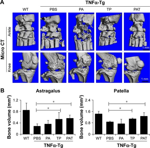 Figure 5 Both TP and PAT reduce bone erosion in TNFα-Tg mice. (A) Longitudinal sections of 3-dimensional reconstructed ankle and knee joints by micro-CT show decreased bone erosion in TP- and PAT-treated mice. (B) Quantitation of bone volume of astragalus and patella. Values are the mean ± SD of 7–10 legs per group. *P<0.05, compared with PBS-treated group.Abbreviations: micro-CT, microcomputed tomography; WT, wild type; TNFα-Tg, tumor necrosis factor α transgenic; PBS, phosphate buffer saline; PA, poly-γ-glutamic acid-grafted di-tert-butyl L-aspartate hydrochloride; TP, triptolide; PAT, TP-loaded poly-γ-glutamic acid-grafted di-tert-butyl L-aspartate hydrochloride.