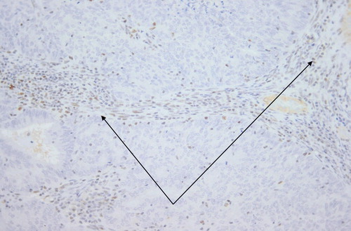Figure 1: Lymphocytes and stromal cell nuclei stain positively (arrows) but the nuclei of tumour cells are negative. 4 μm MLH1 stained section. Original magnification: 200x.