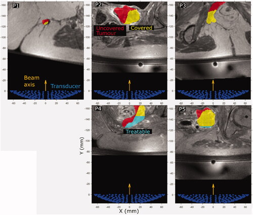 Figure 8. (P1–P5) Cross sections of the predicted treatable volume (cyan), predicted tumor coverage (yellow) and the remaining uncovered and untreatable tumor volume (red) overlaid on patient anatomy (greyscale in-phase MR image). The image slices are those at the position where the interpolated ablated tissue volumes are equal to the expected treatment cell volume (84 mm3). The transducer (138 mm aperture width) is shown for scale.