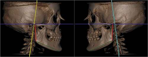 Figure 4. Images and measurements obtained using the SYM 3D protocol that allows mandibular craniometric evaluation.