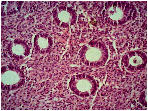 Figure 1. Endometrium of patient Zh., 34, average grade of chronic hepatitis C. 17th day of the menstrual cycle. Hematoxylin and eosin staining, magnification 200×. Glands of rounded shape with a double-row epithelium, single mitoses. Cylindrical cells with smooth apical edge. Stromal cells of rounded shape with limited cytoplasm. Congestion of lymphocytes near glands.