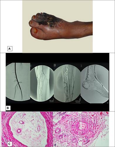 Figure 3 Case 3, (A) gangrene of forefoot, (B) angiography characteristics for Buerger’s disease; (C) Infiltration of inflammatory cells in all layers of the vessel and organized thrombus are suggestive for Buerger’s disease.