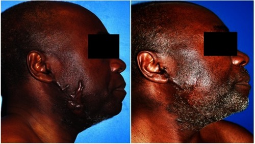 Figure 3 Jugal keloid. Before and after treatment result at 13 months’ follow-up.