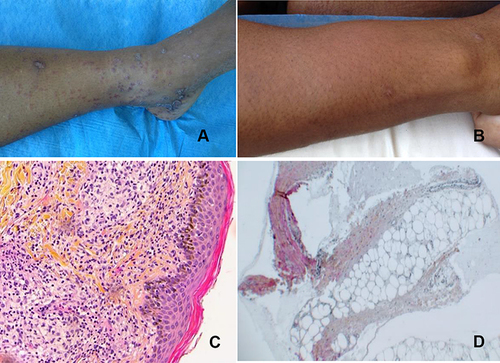 Figure 1 Clinical and pathology examination of skin lesions presented by the patient. (A) Maculopapular rash on the lower limbs with Biett collarette; (B) erythema nodosum on the right forearm; (C) granulomatous dermatitis with a lichenoid infiltrate; (D) septal panniculitis.