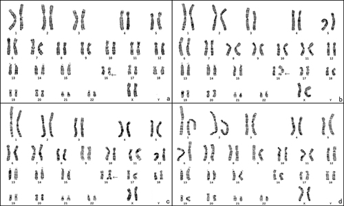 Figure 2 The chromosome karyotype of the patient’s mother. (a) 46, XX, del(16)(q22), black arrow points the deletion at 16q22; (b) 46, XX, fra(16)(q22), black arrow points the fragile site at 16q22; (c) 46, XX, fra(16)tr(16)(q22), black arrow points the duplication of 16q22; (d) 46, XX.