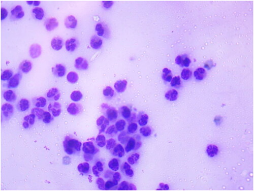 Figure 4. Microscopic examination of milk somatic cells smear stained with Newman stain showing somatic cells (numerous milk somatic cells present in milk smear).