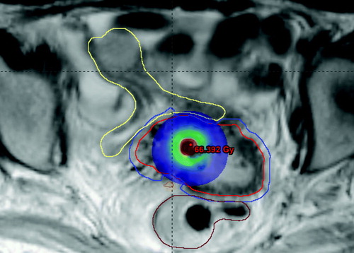 Figure 7.  Dose distribution from IC-BT in a patient. The PTV volume (blue contour) for IMRT-patch-plan extends into OARs, and the patient would be a good candidate for IC/IS-BT.