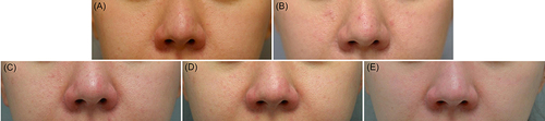 Figure 3 Clinical photographs of a patient before and after combined treatment with MFU-V and intradermal INCO. Compared to the (A) baseline (pore count, 1353; pore density, 39.71%), the countable facial pores decreased at (B) 1 week (pore count, 1023; pore density, 29.62%), (C) 4 weeks (pore count, 558; pore density, 16.24%), (D) 12 weeks (pore count, 448; pore density, 13.02%), and (E) 24 weeks (pore count, 308; pore density, 8.94%) after the combined treatment.
