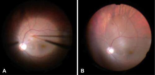 Figure 2 Intraoperative photographs. Before (A) and after (B) subretinal balanced salt solution (BSS) injection using a 41-gauge De Juan cannula. Subretinal BSS created a serous retinal detachment that formed a pocket right under the inferotemporal arcade, which spread to reach the perfluorocarbon liquid bubble.