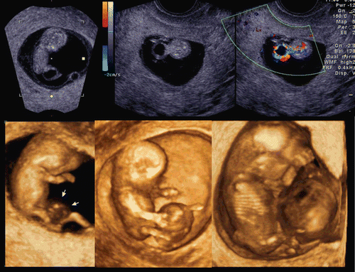 Figure 50.  Bladder exstrophy in the first trimester. (upper) Cystic formation between bilateral umbilical arteries. No bladder is visible inside of the fetus. (lower) 3D US images at 10, 11 and 12 weeks from the left. Rapid increase in size of external bladder is clearly demonstrated.