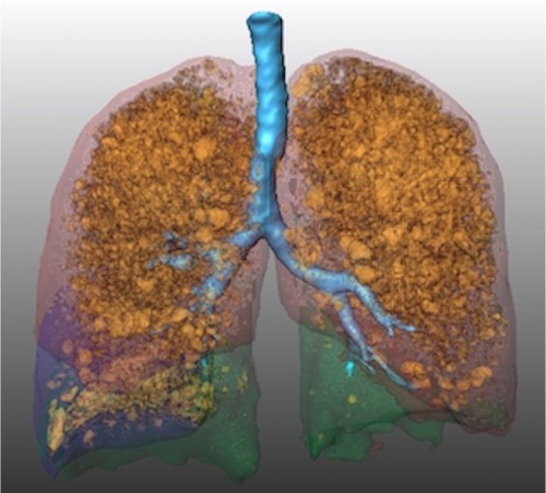 Figure 1 Coronary 3D surface view of a processed HRCT scan of the lung acquired in inspiration depicting the lung lobes (semitransparent green, lower lobes; semitransparent red, upper lobe; semitransparent blue, right middle lobe) and voxels with a density below −950 HU (orange).