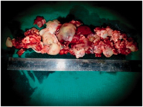 Figure 5. Excised polypoidal mass.