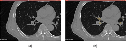 Figure 1. CT image as shown in the 3DSlicer interface (a), and segmented bronchi on the same slice as yellow label map (b).