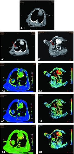 Figure 1 All images are obtained from the same investigated rabbit. (A0) CT scanning image shows normal tissue in the lung before tumor inoculation. (A1) CT enhancement scanning image shows an irregular soft tissue mass in the lobe of the left lung two weeks after tumor inoculation (red arrow). CT perfusion scanning images show PEI (A2), PV (A3), and BV (A4). (B1) MRI enhanced scanning image shows an irregular soft tissue mass in the right lung two weeks after tumor inoculation (red arrow). MR perfusion scanning images show WIR (B2), WOR (B3), and MER (B4) in the tumor tissue (red arrows). There is an abundant supply of blood vessels in the tumor rim, while the central portions of the tumor are ischemic.