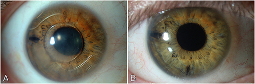 Figure 1 Anterior segment photograph of a patient who underwent DMEK for PIOL-related corneal decompensation. (A) Corneal decompensation in an eye with an angle-support, phakic intraocular lens (BCVA = 20/40 Snellen). (B) 8 years after staged surgery (PIOL explantation plus RLE, followed by DMEK), showing a clear cornea (BCVA = 20/20 Snellen).
