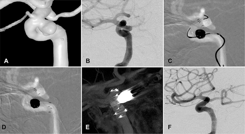 Figure 2 The EP2 stent markers were symmetrical in proximal and distal parent artery. (A) the 3D reconstruction diagram of aneurysm at the right paraclinoid aneurysms; (B) the result of intraoperative at right paraclinoid aneurysms; (C) the process of EP2 stent (23mm) were released intraoperation; (D) the result of EP2 stent were released post-operation, the proximal and distal markers were symmetrical; (E) sagittal view of the stent in Dyna-CT; (F) the follow-up results of stent-assisted treatment for paraclinoid aneurysms.