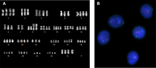 Figure 7 Cytogenetic abnormalities before and after mogamulizumab administration. After the first course of mogamulizumab, the hypothetraploid clone showed by karyotype and confirmed by FISH (A) was cleared and only a second clone remained detectable by FISH (B).