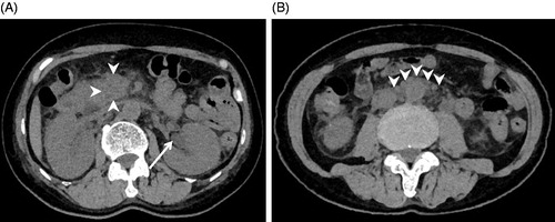 Figure 2. Abdominal computed tomography (CT) at 23 days after admission. (A) CT images showing increased concentration in the pancreas head (arrowheads) and left hydronephrosis (arrow); (B) Increased fat tissue concentrations around the aorta and in the retroperitoneum (arrowheads).