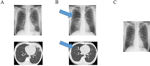 Figure 1 Chest X-ray and computed tomography images. (A) Chest images of the patient at the initial visit showing the presence of airspace consolidation in the left lung. (B) Chest images 4 months after the initial visit showing right pneumothorax (arrows). (C) Last chest image after improvement of pneumothorax.