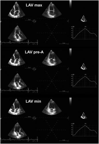 Figure 3. Maximum, minimum and pre-A left atrial volume (LAV) assessed by three-dimensional echocardiography.